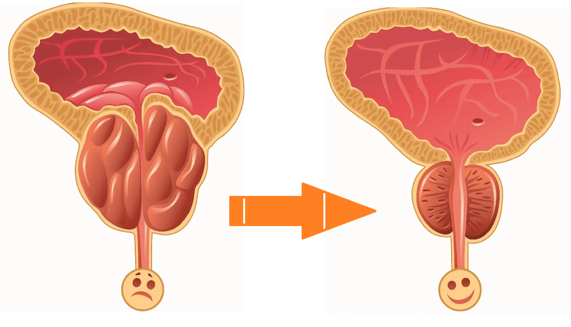 Vpliv Uromexil Forte na prostato s prostatitisom in adenomom